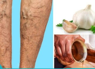 ვარიკოზული ვენების მკურნალობა ხალხური მედიცინით