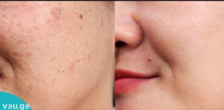 კანის გათეთრება და გაწმენდა შავი ლაქებისგან ახალი ლოსიონით