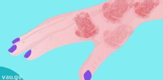 როგორ გამოვიყენოთ კურკუმა ფსორიაზის სამკურნალოდ?!