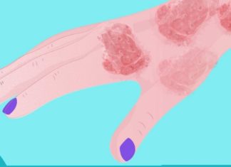 როგორ გამოვიყენოთ კურკუმა ფსორიაზის სამკურნალოდ?!