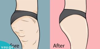 Ეს კრემი შეამცირებს თქვენს ცელულიტს 7 დღის განმავლობაში! საოცარი შედეგია, მე ის მიყვარს!