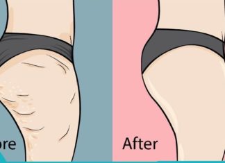 Ეს კრემი შეამცირებს თქვენს ცელულიტს 7 დღის განმავლობაში! საოცარი შედეგია, მე ის მიყვარს!