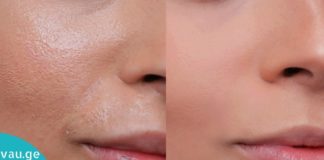 ნატურალური საშინაო ტონიკი ცხიმიანი კანისთვის