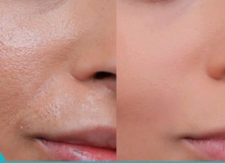 ნატურალური საშინაო ტონიკი ცხიმიანი კანისთვის