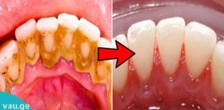 როგორ მოვიცილოთ კბილებიდან ნადები?! 3 რჩევა, რომლის შესახებაც სტომატოლოგები დუმან