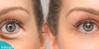 განსაცვიფრებელი რეცეპტი თვალების ქვეშ შეშუპების მოსაშორებლად