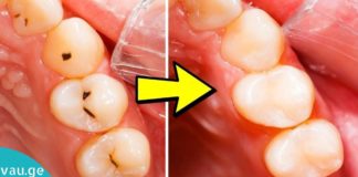 როგორ ვუმკურნალოთ კარიესს?