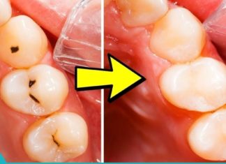 როგორ ვუმკურნალოთ კარიესს?