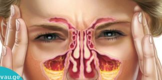 როგორ მოვირჩინოთ ჰაიმორიტი შავი ჩაით?!