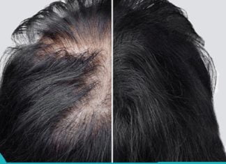 Სახლში დამზადებული რეცეპტი თმის ცვენის საწინააღმდეგოდ