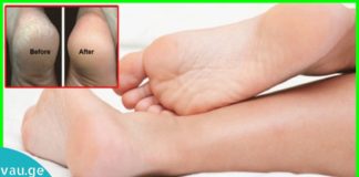 დამსკდარი ქუსლების მკურნალობა ხალხური მედიცინის დახმარებით