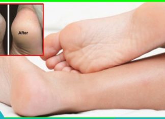 დამსკდარი ქუსლების მკურნალობა ხალხური მედიცინის დახმარებით