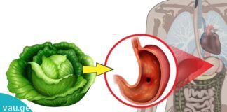 კომბოსტოს წვენი მკურნალობს კუჭის / თორმეტგოჯა ნაწლავის წყლულს