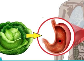 კომბოსტოს წვენი მკურნალობს კუჭის / თორმეტგოჯა ნაწლავის წყლულს