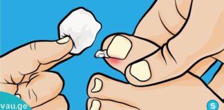 ნახეთ რა მარტივია ჩაზრდილი ფრჩხილის მკურნალობა ქირურგიული ჩარევების გარეშე