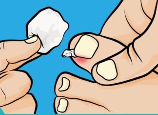 ნახეთ რა მარტივია ჩაზრდილი ფრჩხილის მკურნალობა ქირურგიული ჩარევების გარეშე