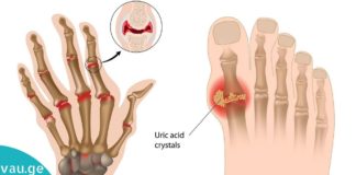 პოპულარული რეცეპტი შარდმჟავას სახსრებიდან გამოსადევნად