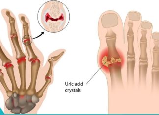პოპულარული რეცეპტი შარდმჟავას სახსრებიდან გამოსადევნად