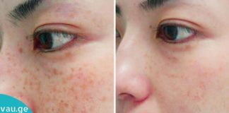 7 ბუნებრივი გზა სახის კანის სამკურნალოდ და ლაქების მოსაშორებლად