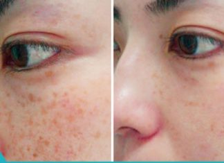 7 ბუნებრივი გზა სახის კანის სამკურნალოდ და ლაქების მოსაშორებლად