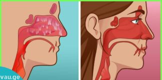 ჰაიმორიტის სამკურნალო მალამო – რა საშუალებები არაღ ვცადე – მხოლოდ ეს მალამო დამეხმარა!