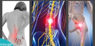 რადიკულიტის მკუნალობა ხალხური მედიცინის დახმარებით