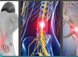 რადიკულიტის მკუნალობა ხალხური მედიცინის დახმარებით