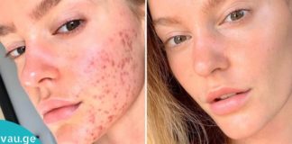 აკნეს სამკურნალო საშუალება: უბრალოდ შეიძინეთ ეს 3 იაფი ინგრედიენტი აფთიაქში