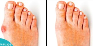 Სამკურნალო მცენარეები, რომლებიც ხელს უწყობენ ბურსიტის წინააღმდეგ ბრძოლას