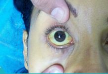 Მაღალი ბილირუბინის გამომწვევი მიზეზები, რისი ცოდნაც აუცილებელია