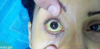 Მაღალი ბილირუბინის გამომწვევი მიზეზები, რისი ცოდნაც აუცილებელია