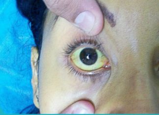 Მაღალი ბილირუბინის გამომწვევი მიზეზები, რისი ცოდნაც აუცილებელია