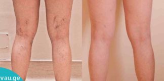5 საოჯახო საშუალება ვარიკოზული ვენების დროს