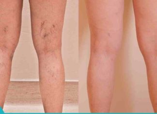 5 საოჯახო საშუალება ვარიკოზული ვენების დროს