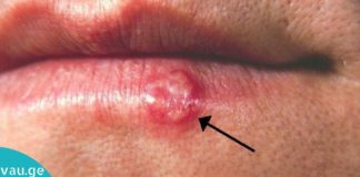 კორვალოლი და ვალოკორინი შესანიშნავი წამალია ჰერპესისთვის. მე დიდი ხანია ვიყენებ მას – ყოველთვის ამართლებს!