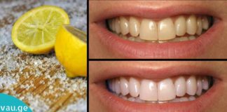 ლიმონის გამოყენების 4 გზა პირის ღრუს პრობლემების გადასაჭრელად