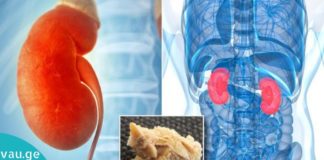 დაემშვიდობეთ თირკმელებში კენჭებს მხოლოდ ერთ კვირაში-საოცარი რეცეფტი!