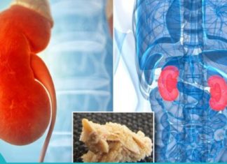 დაემშვიდობეთ თირკმელებში კენჭებს მხოლოდ ერთ კვირაში-საოცარი რეცეფტი!