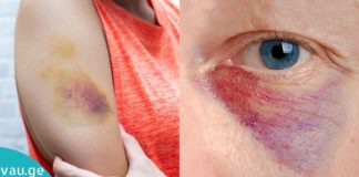 Როგორ მოვიშოროთ სისხლჩაქცევები უმოკლეს დროში სახესა და სხეულზე?!