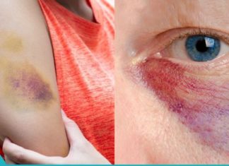 Როგორ მოვიშოროთ სისხლჩაქცევები უმოკლეს დროში სახესა და სხეულზე?!