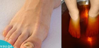 ფრჩხილის სოკოს პრობლემები და მკურნალობა ხალხური საშუალებებით