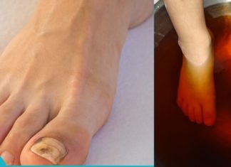 ფრჩხილის სოკოს პრობლემები და მკურნალობა ხალხური საშუალებებით