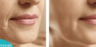 ყველაზე ეფექტური ნიღაბი ნაოჭების წინააღმდეგ–  საოცარი შედეგი 5 პროცედურის შემდეგ!