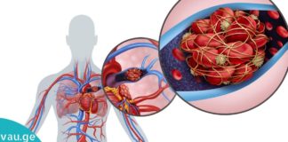 Პრევენცია ყოველთვის უკეთესია, ვიდრე მკურნალობის პროცესი! აიცილეთ თავიდან თრომბის რისკი