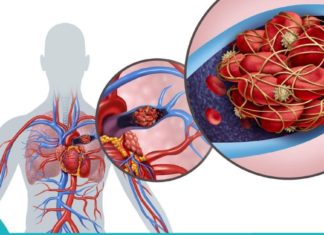 Პრევენცია ყოველთვის უკეთესია, ვიდრე მკურნალობის პროცესი! აიცილეთ თავიდან თრომბის რისკი