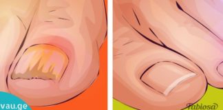 3 ხალხური მეთოდი სოკოს სამკურნალოდ