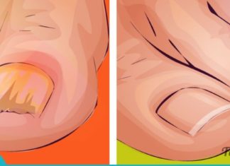 3 ხალხური მეთოდი სოკოს სამკურნალოდ