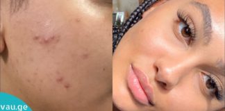 აშორებს ყველანაირ მეჭეჭს, მუწუკს, ფიბრომას და ასაკობრივ ლაქას პირველი გამოყენების შემდეგ. Ცდად ღირს