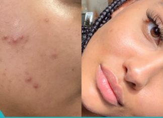 აშორებს ყველანაირ მეჭეჭს, მუწუკს, ფიბრომას და ასაკობრივ ლაქას პირველი გამოყენების შემდეგ. Ცდად ღირს