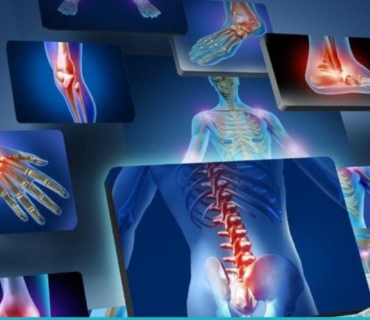 საკვები, რომლის მიღებაც აუცილებლად უნდა გამოირიცხოს ართრიტის დროს